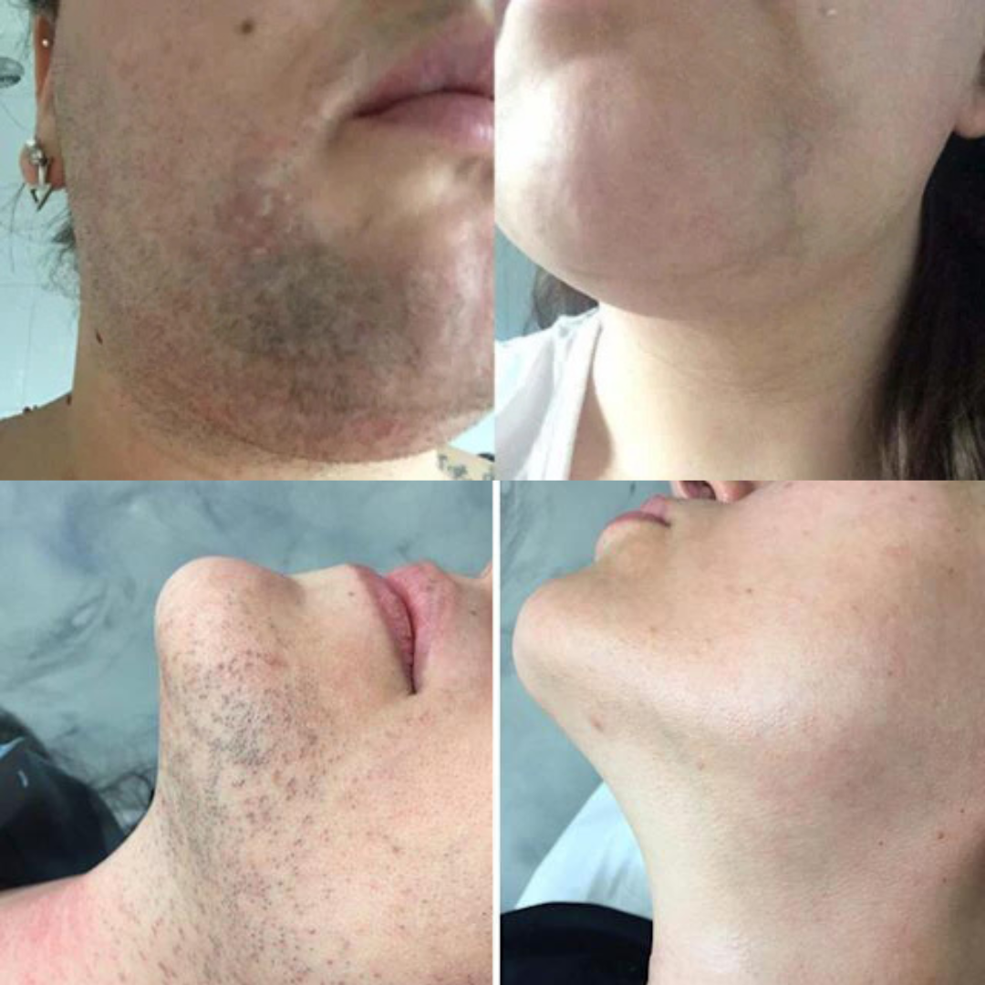 PCOS Hair Removal